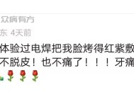 电焊脸烤的疼用芦荟解决的方法